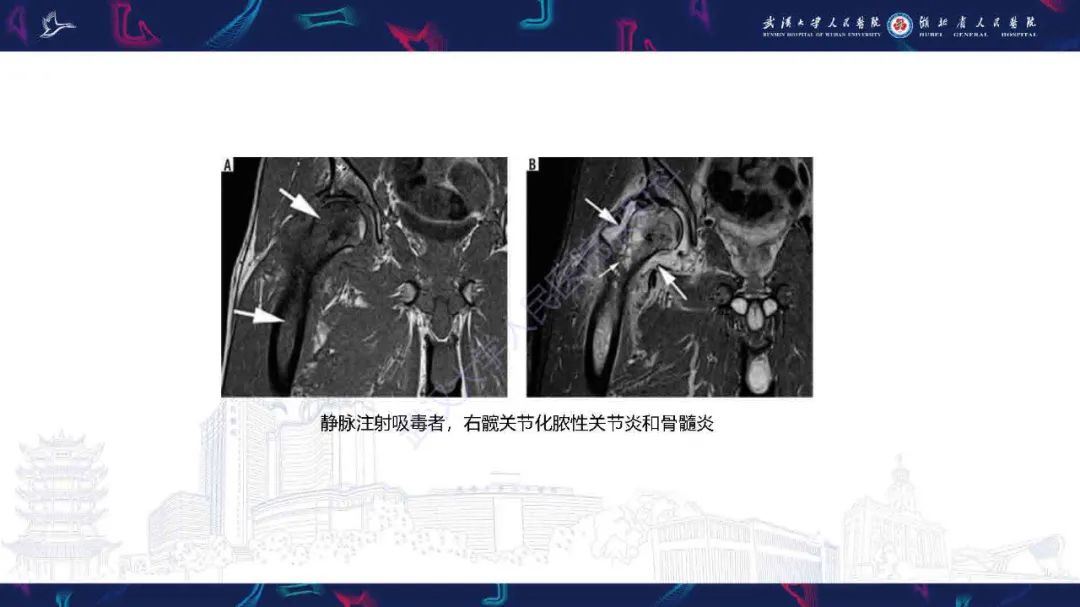 影像PPT - 【PPT】成人髋部疼痛MRI诊断-14