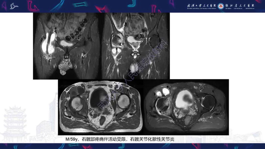 影像PPT - 【PPT】成人髋部疼痛MRI诊断-15