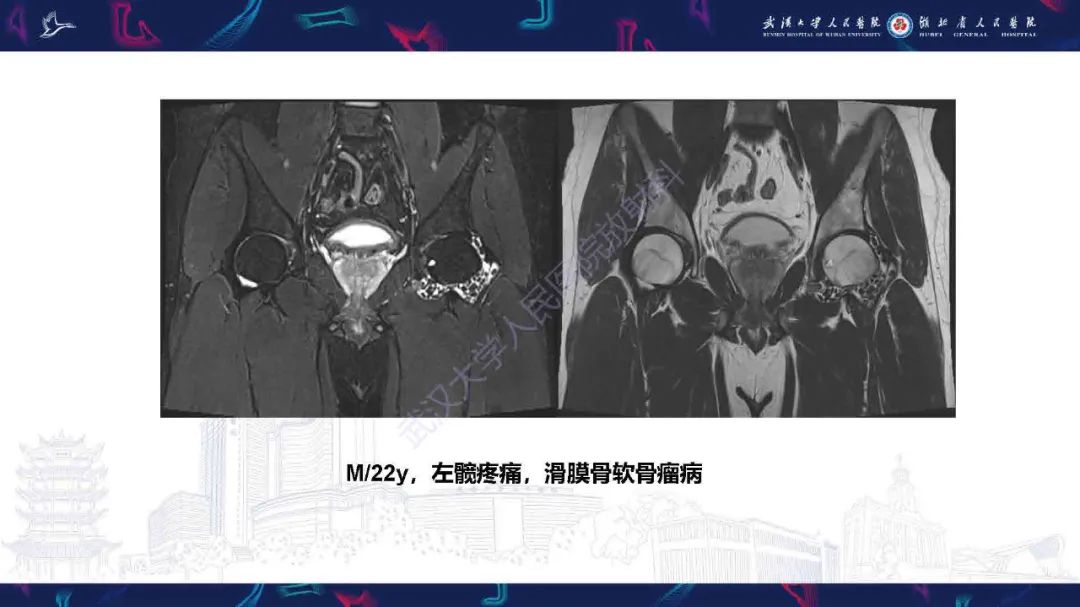 影像PPT - 【PPT】成人髋部疼痛MRI诊断-17