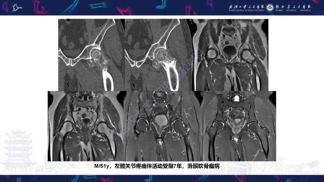 影像PPT - 【PPT】成人髋部疼痛MRI诊断-18