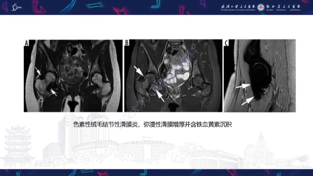 影像PPT - 【PPT】成人髋部疼痛MRI诊断-20