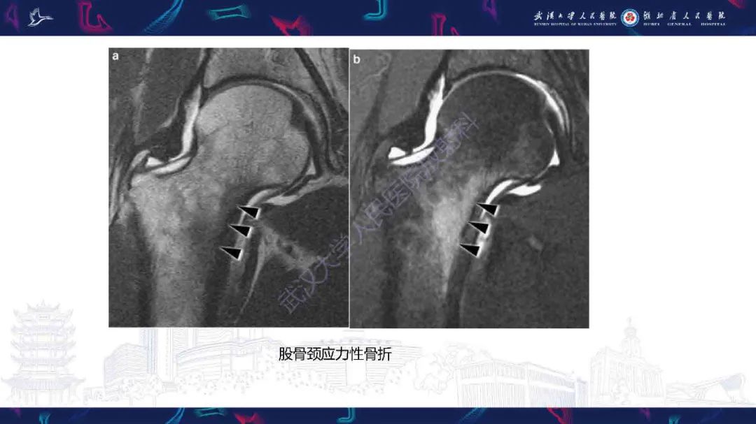 影像PPT - 【PPT】成人髋部疼痛MRI诊断-22