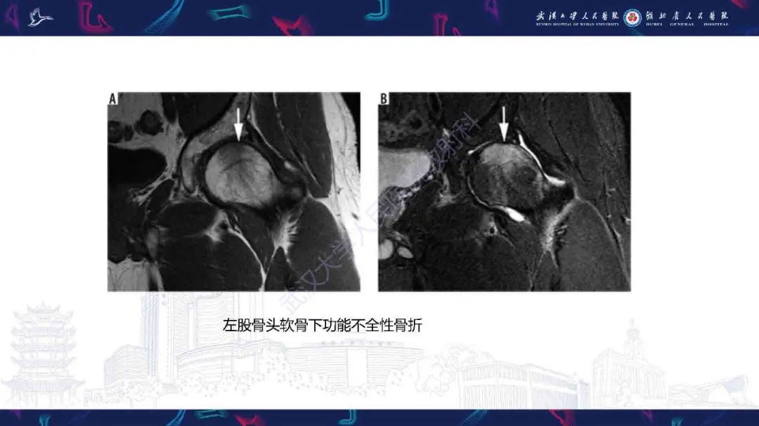 影像PPT - 【PPT】成人髋部疼痛MRI诊断-23