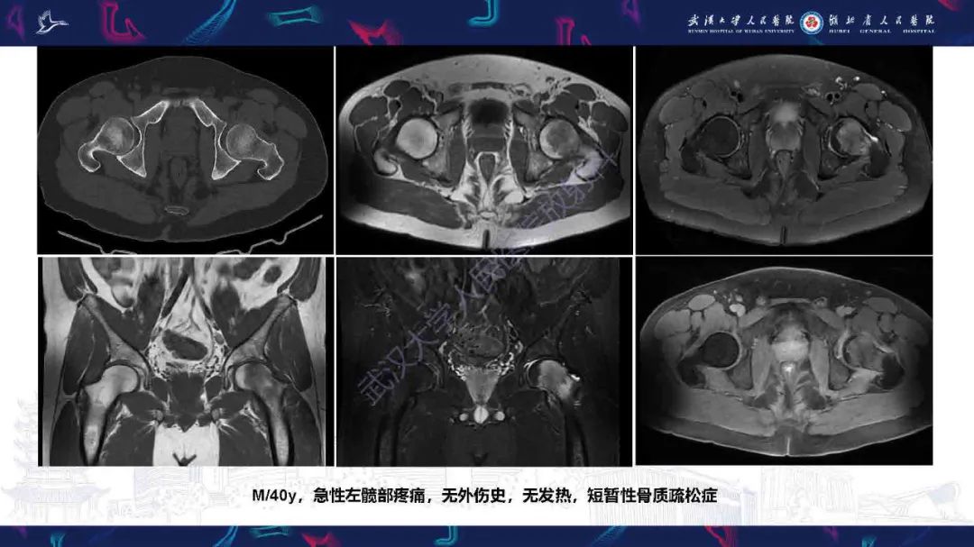 影像PPT - 【PPT】成人髋部疼痛MRI诊断-25