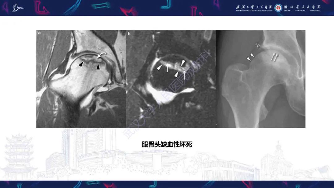 影像PPT - 【PPT】成人髋部疼痛MRI诊断-27