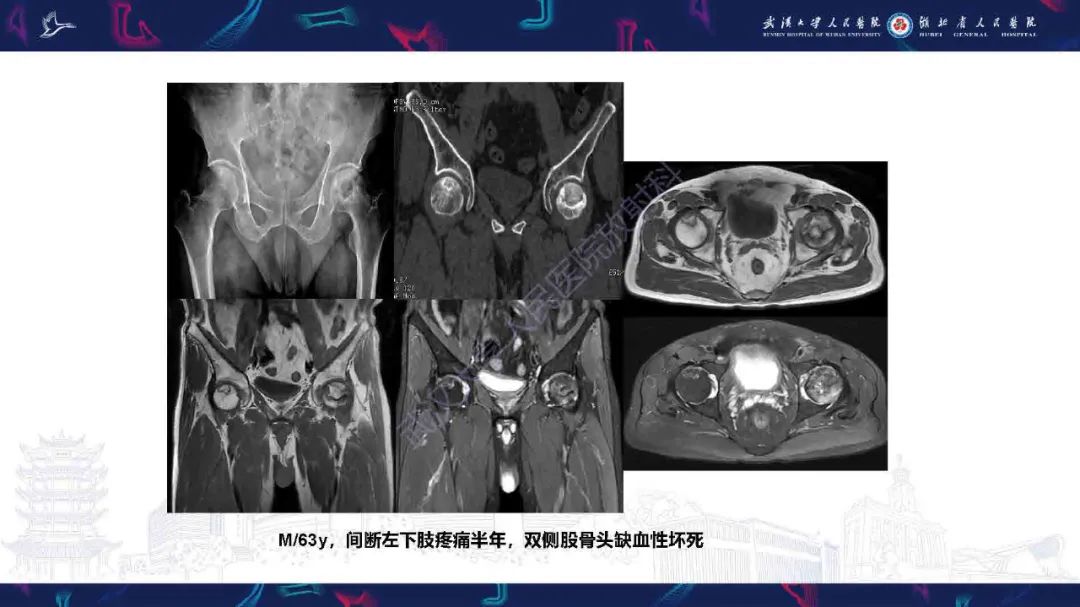 影像PPT - 【PPT】成人髋部疼痛MRI诊断-28