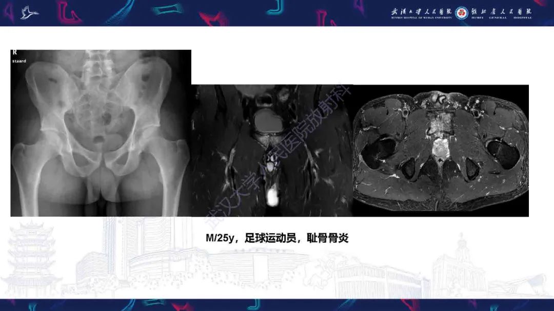 影像PPT - 【PPT】成人髋部疼痛MRI诊断-30