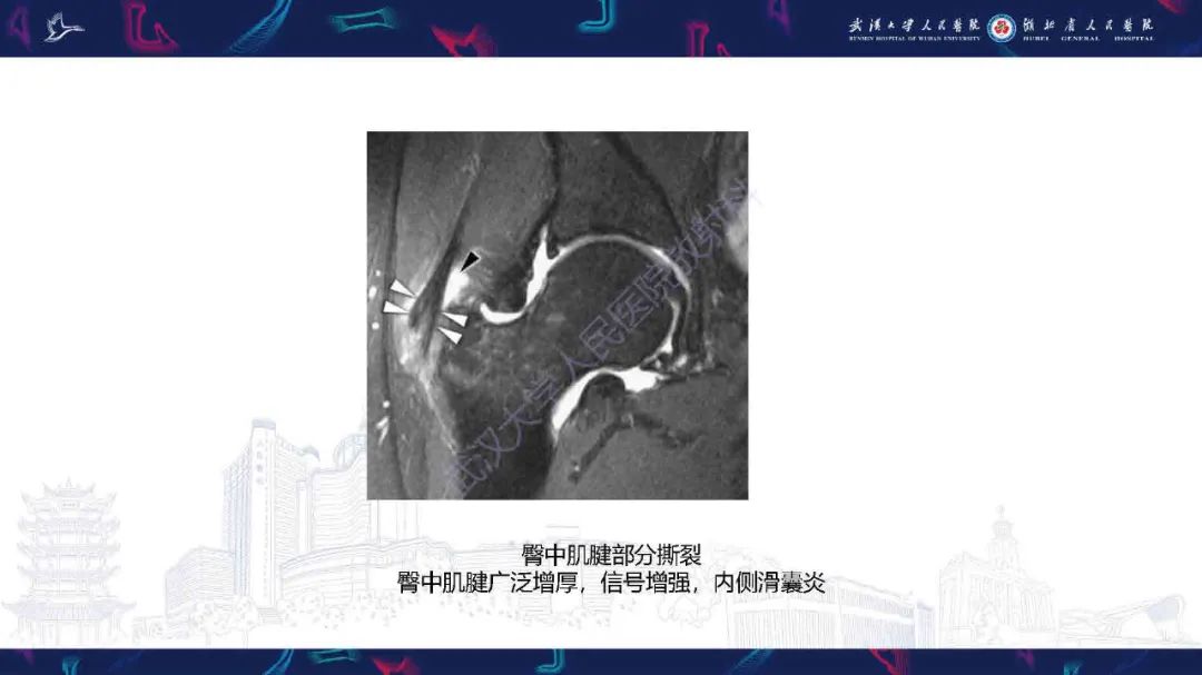 影像PPT - 【PPT】成人髋部疼痛MRI诊断-33