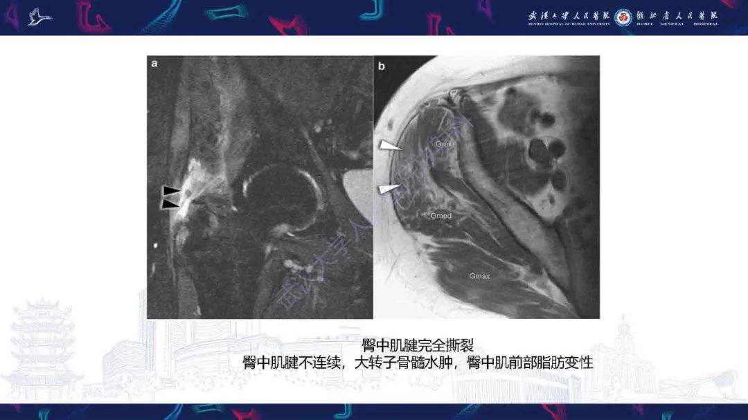 影像PPT - 【PPT】成人髋部疼痛MRI诊断-34