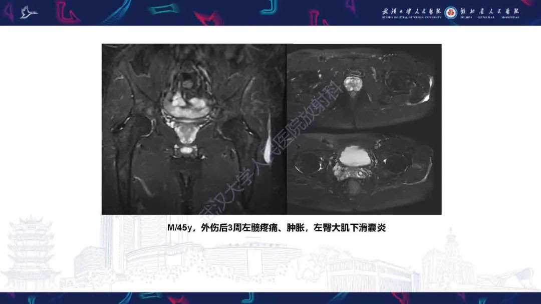 影像PPT - 【PPT】成人髋部疼痛MRI诊断-36