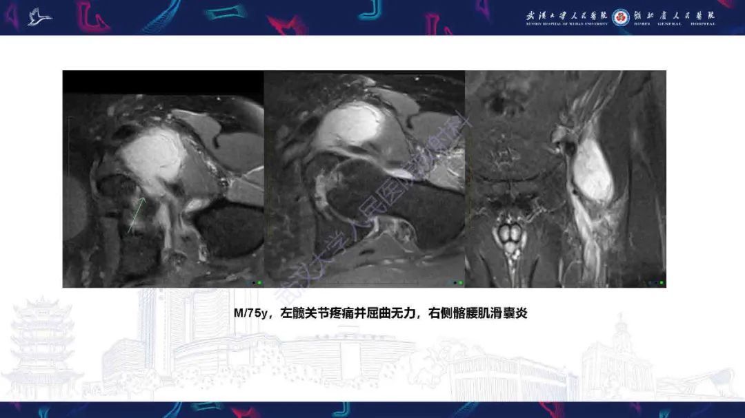 影像PPT - 【PPT】成人髋部疼痛MRI诊断-38