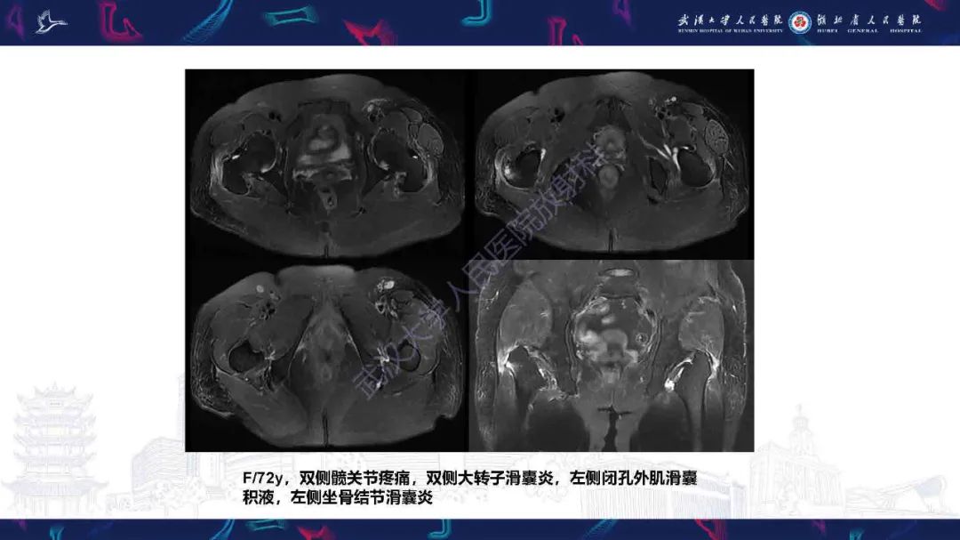 影像PPT - 【PPT】成人髋部疼痛MRI诊断-37