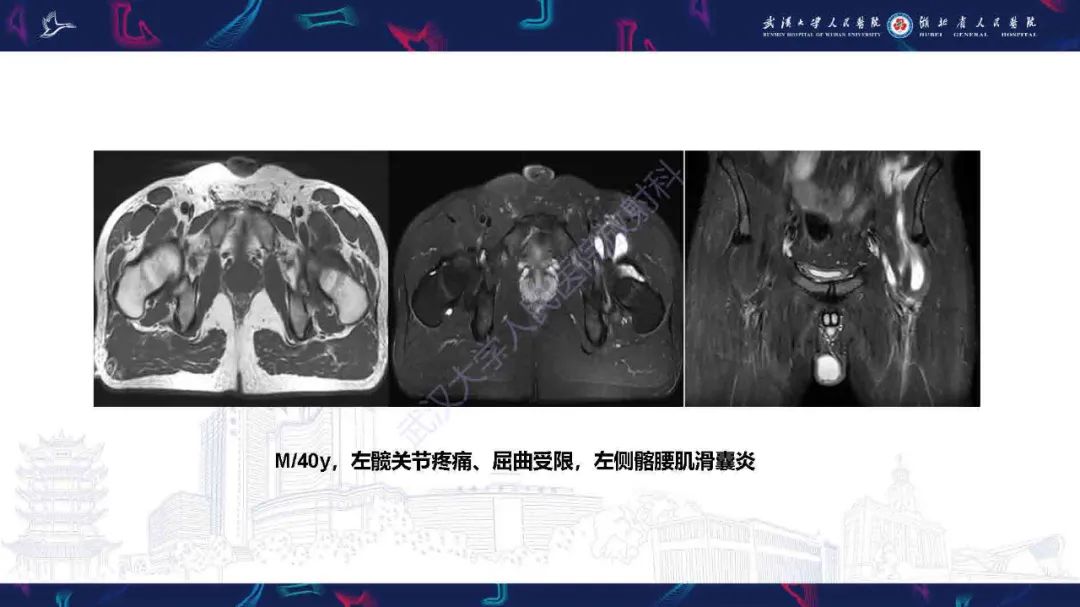 影像PPT - 【PPT】成人髋部疼痛MRI诊断-39