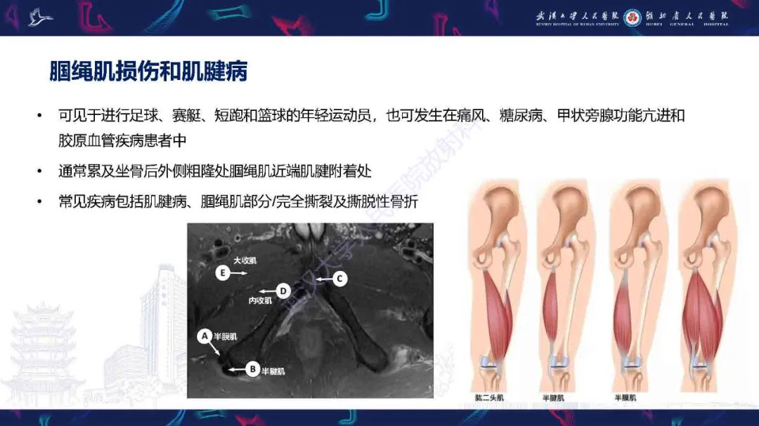 影像PPT - 【PPT】成人髋部疼痛MRI诊断-40