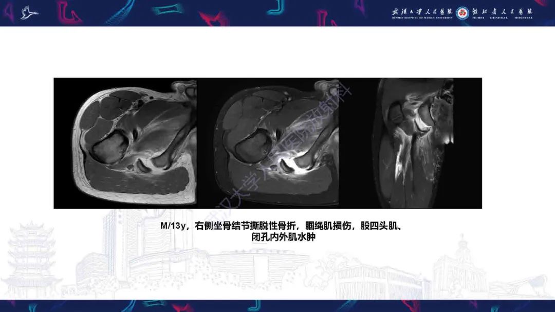 影像PPT - 【PPT】成人髋部疼痛MRI诊断-41