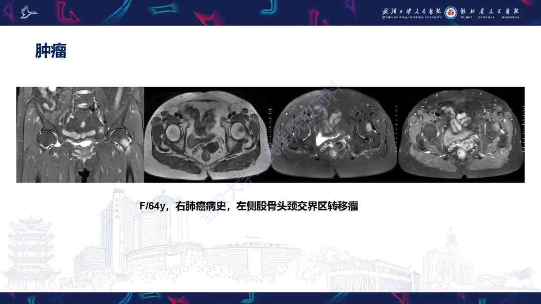 影像PPT - 【PPT】成人髋部疼痛MRI诊断-42