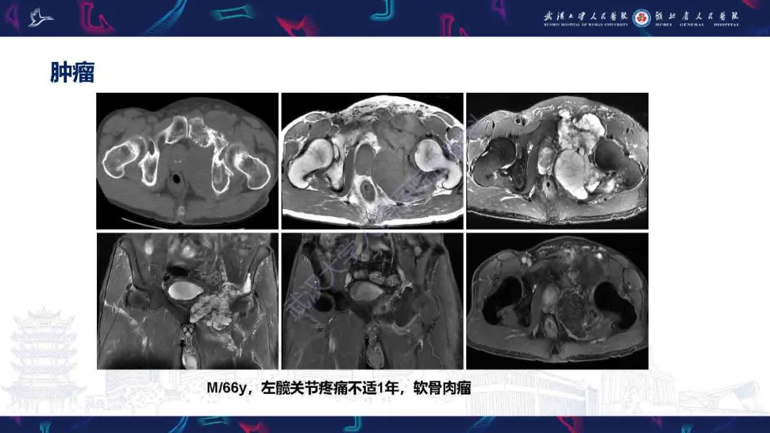 影像PPT - 【PPT】成人髋部疼痛MRI诊断-43