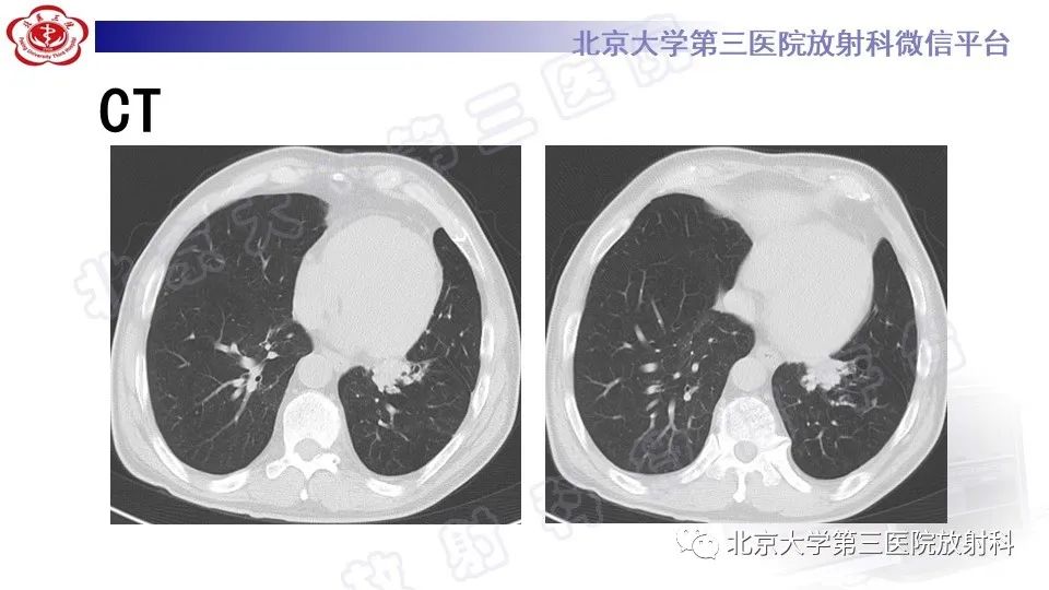 影像PPT - 【PPT】肺支气管闭锁-3