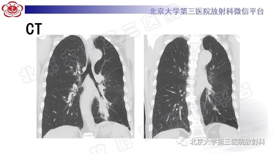 影像PPT - 【PPT】肺支气管闭锁-4