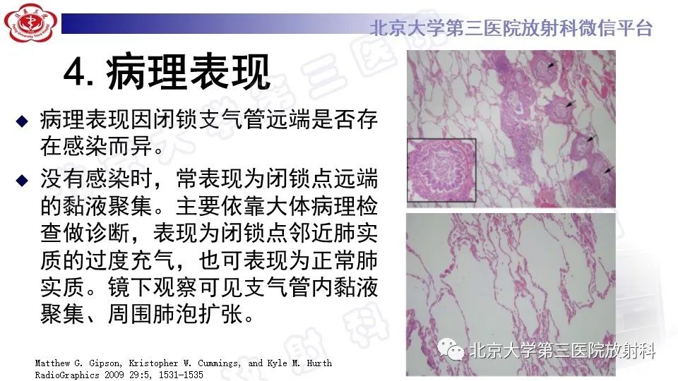 影像PPT - 【PPT】肺支气管闭锁-13