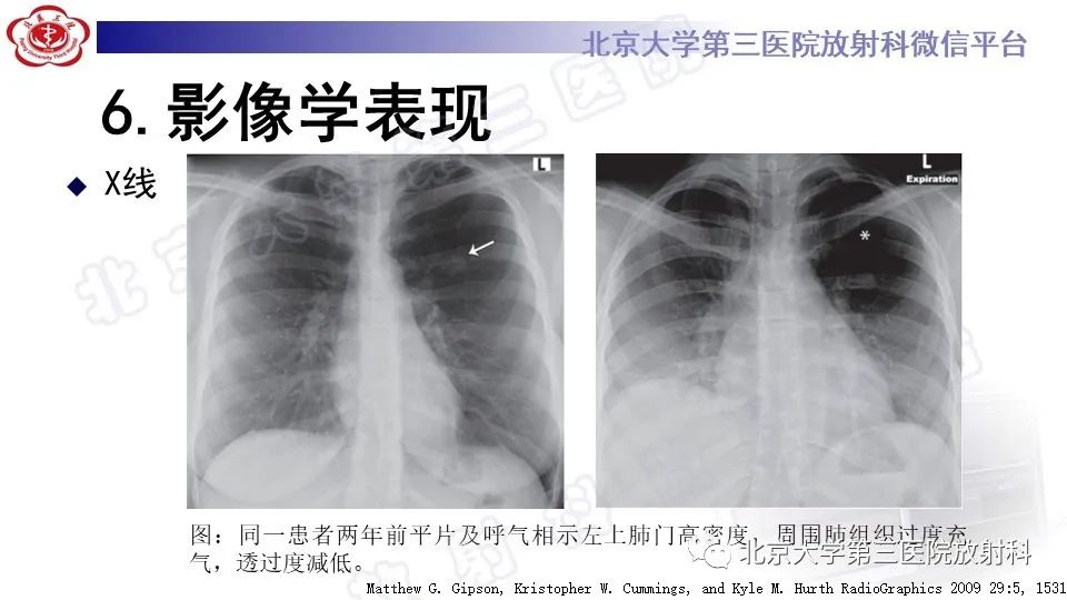 影像PPT - 【PPT】肺支气管闭锁-16