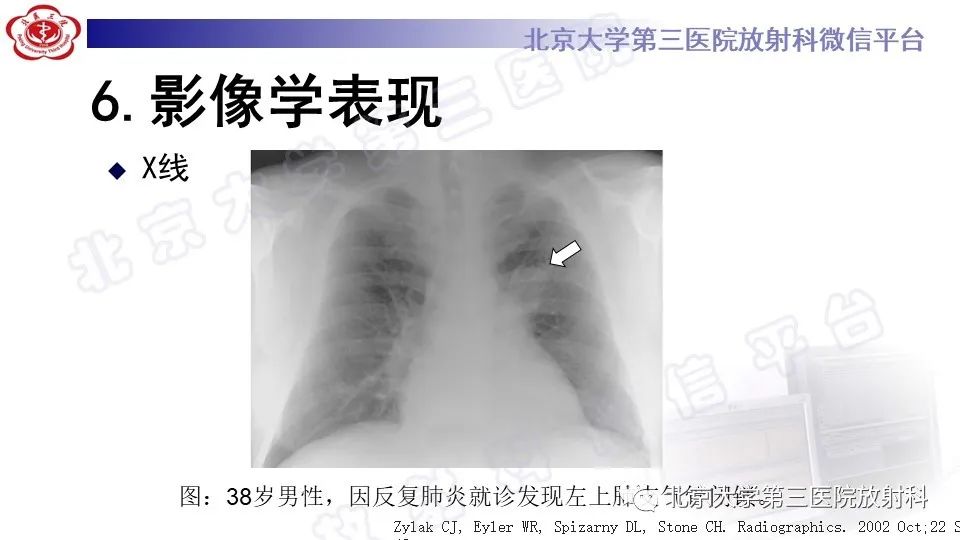 影像PPT - 【PPT】肺支气管闭锁-17