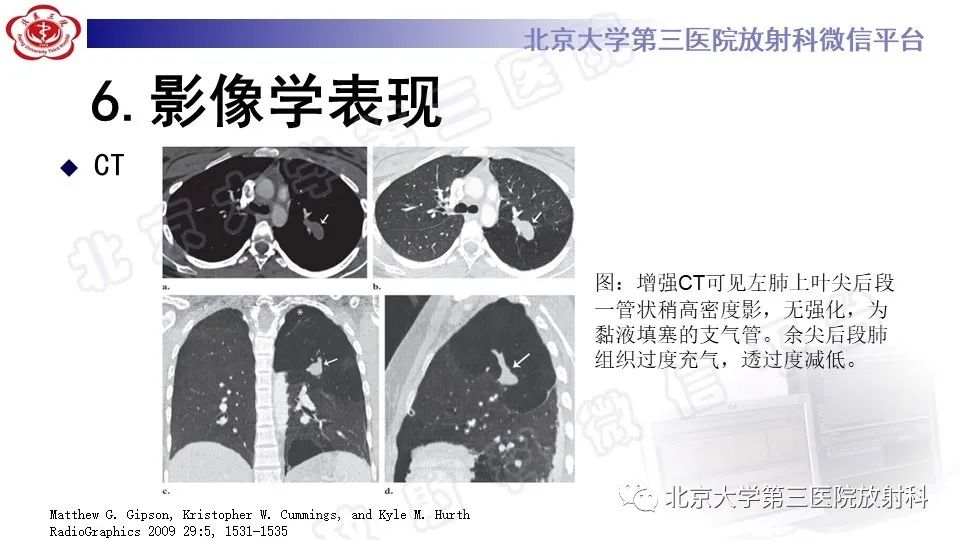 影像PPT - 【PPT】肺支气管闭锁-19