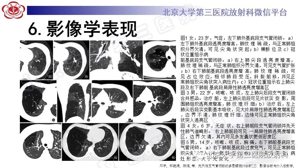影像PPT - 【PPT】肺支气管闭锁-21