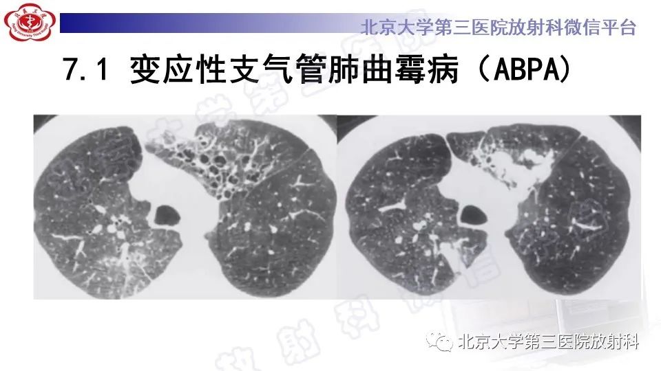 影像PPT - 【PPT】肺支气管闭锁-24