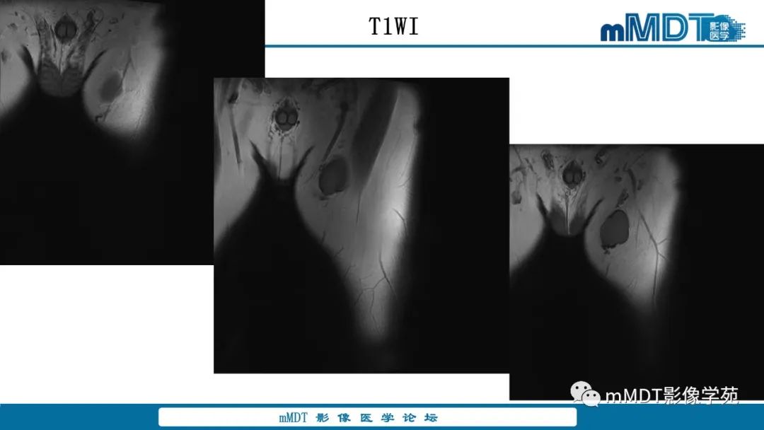 影像PPT - 【病例】大腿孤立性纤维瘤1例MR影像表现-2