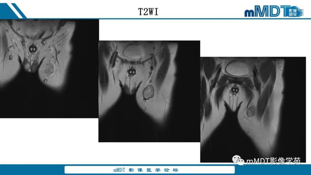 影像PPT - 【病例】大腿孤立性纤维瘤1例MR影像表现-3