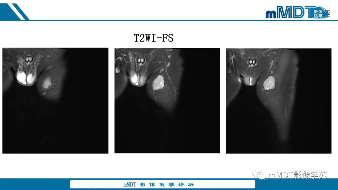 影像PPT - 【病例】大腿孤立性纤维瘤1例MR影像表现-4
