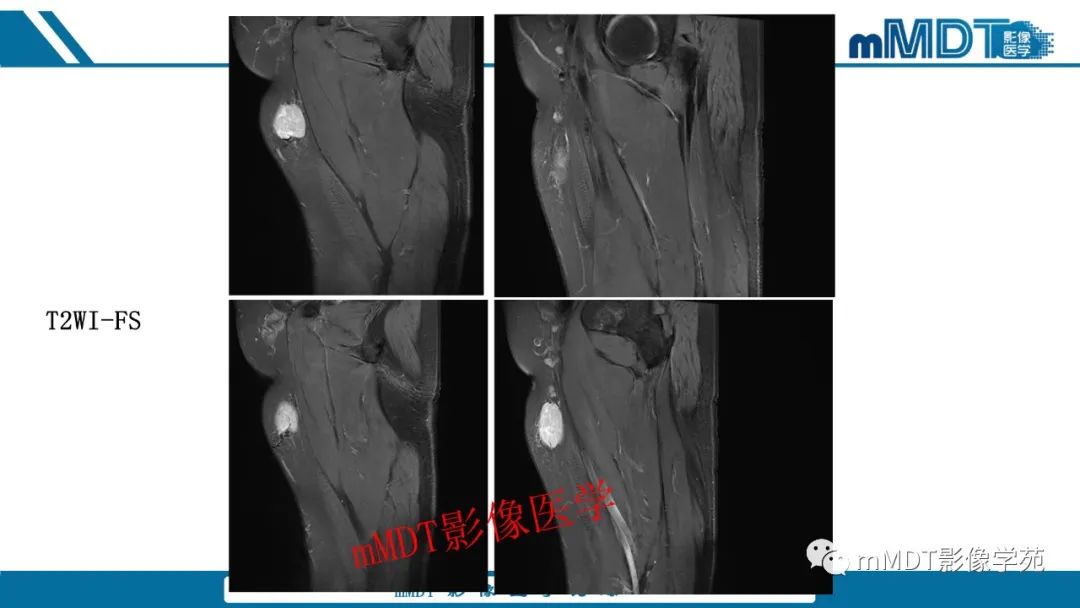 影像PPT - 【病例】大腿孤立性纤维瘤1例MR影像表现-5