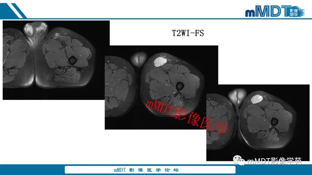 影像PPT - 【病例】大腿孤立性纤维瘤1例MR影像表现-6