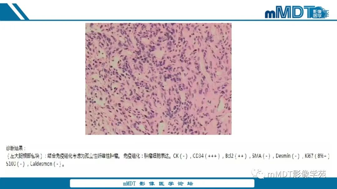 影像PPT - 【病例】大腿孤立性纤维瘤1例MR影像表现-9
