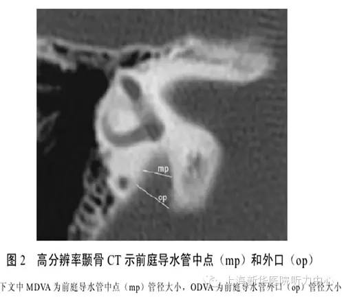 影像PPT - 大前庭导水管综合征的CT影像学诊断-2 影像PPT - 大前庭导水管综合征的CT影像学诊断-2