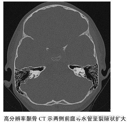 影像PPT - 大前庭导水管综合征的CT影像学诊断-3 影像PPT - 大前庭导水管综合征的CT影像学诊断-3