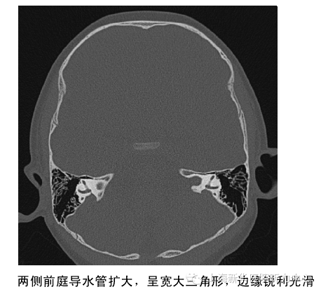 影像PPT - 大前庭导水管综合征的CT影像学诊断-4 影像PPT - 大前庭导水管综合征的CT影像学诊断-4