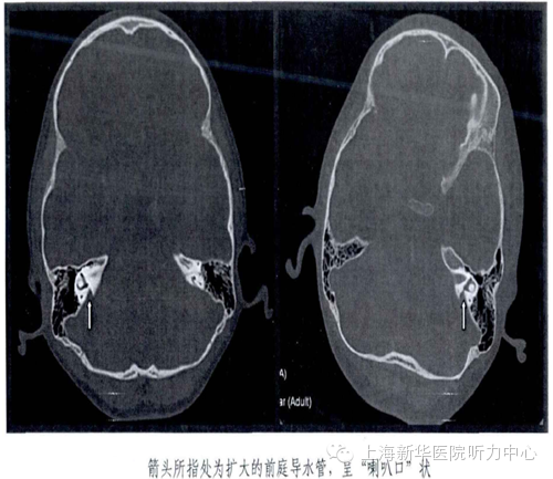 影像PPT - 大前庭导水管综合征的CT影像学诊断-7 影像PPT - 大前庭导水管综合征的CT影像学诊断-7