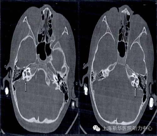 影像PPT - 大前庭导水管综合征的CT影像学诊断-8 影像PPT - 大前庭导水管综合征的CT影像学诊断-8