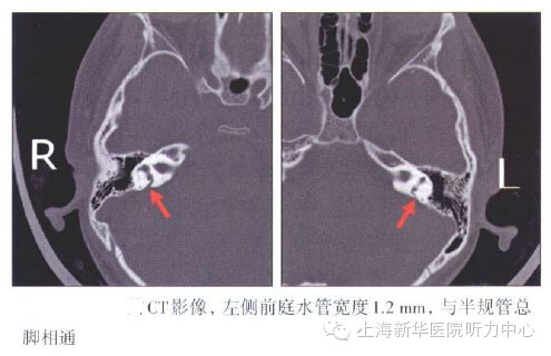影像PPT - 大前庭导水管综合征的CT影像学诊断-9 影像PPT - 大前庭导水管综合征的CT影像学诊断-9