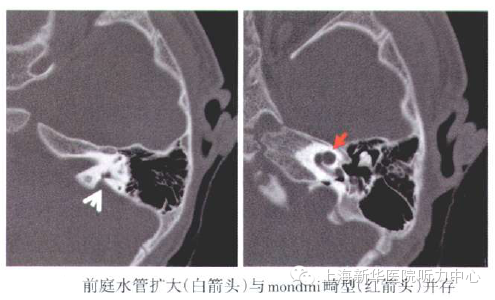 影像PPT - 大前庭导水管综合征的CT影像学诊断-10 影像PPT - 大前庭导水管综合征的CT影像学诊断-10