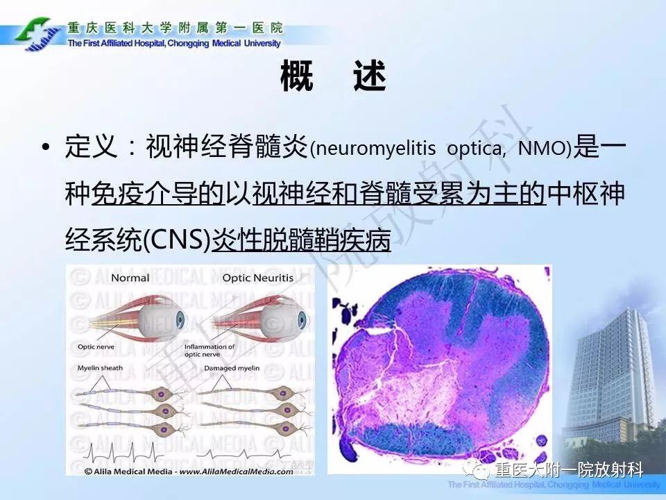 影像PPT - 【PPT】视神经脊髓炎临床及MRI特征-2