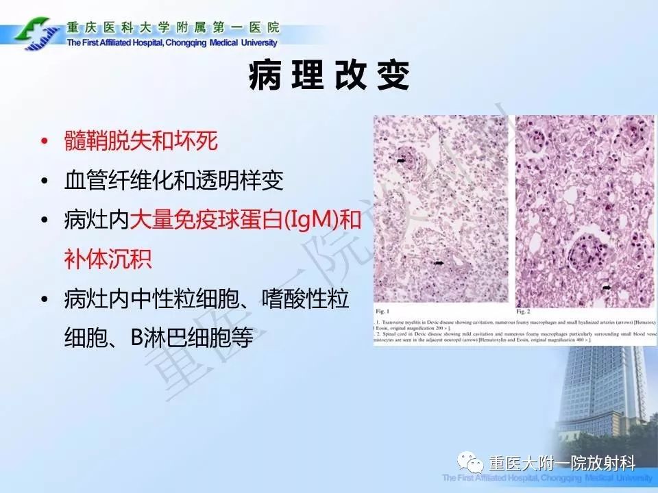 影像PPT - 【PPT】视神经脊髓炎临床及MRI特征-6