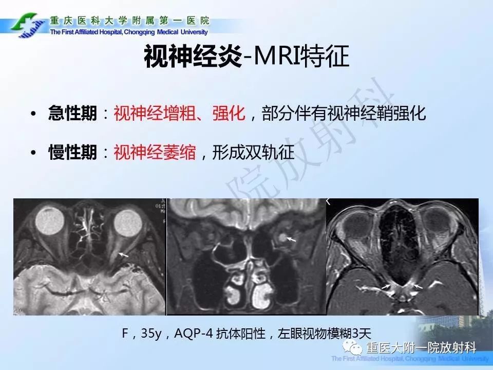 影像PPT - 【PPT】视神经脊髓炎临床及MRI特征-12