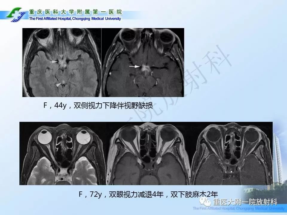 影像PPT - 【PPT】视神经脊髓炎临床及MRI特征-13