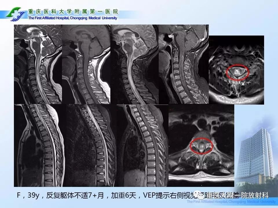 影像PPT - 【PPT】视神经脊髓炎临床及MRI特征-16