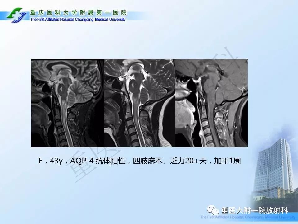 影像PPT - 【PPT】视神经脊髓炎临床及MRI特征-18