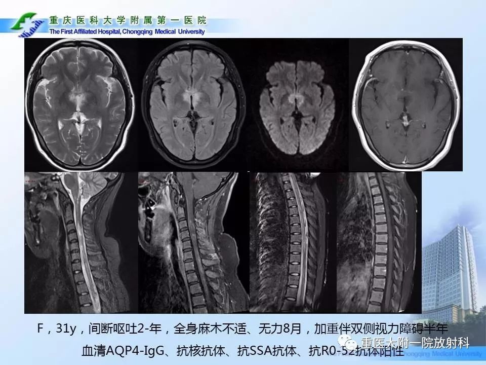 影像PPT - 【PPT】视神经脊髓炎临床及MRI特征-21