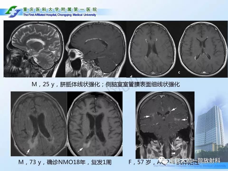 影像PPT - 【PPT】视神经脊髓炎临床及MRI特征-23